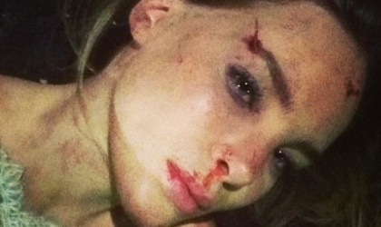 Belinda publica foto del peor accidente de su vida