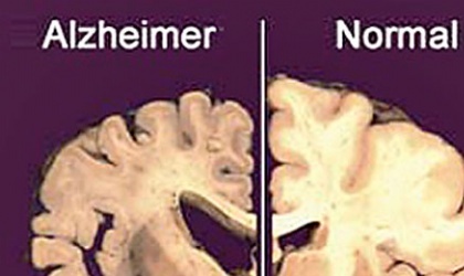 Pfizer combate el  Alzheimer, una enfermedad que ha aumentado en los ltimos aos