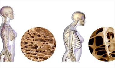 /vidasocial/medico-de-leche-nevada-explica-como-prevenir-la-osteoporosis/82781.html