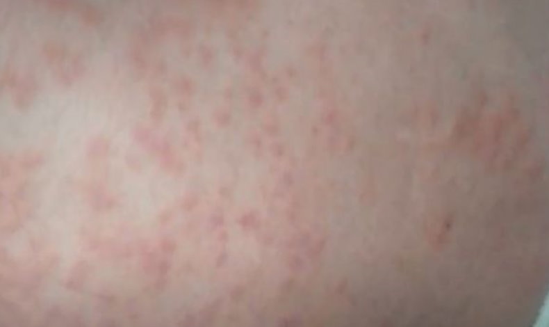 Minsa confirma 268 casos de alergias por pelusa de polillas