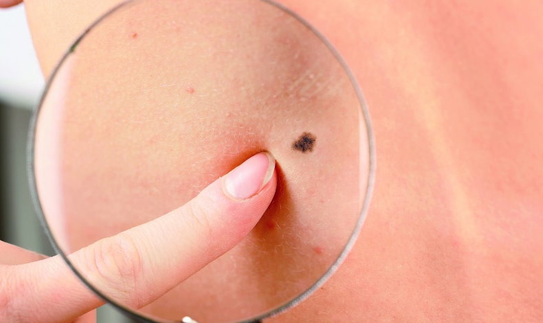 En este verano el melanoma es el cncer de piel ms agresivo que existe y se puede confundir con un lunar