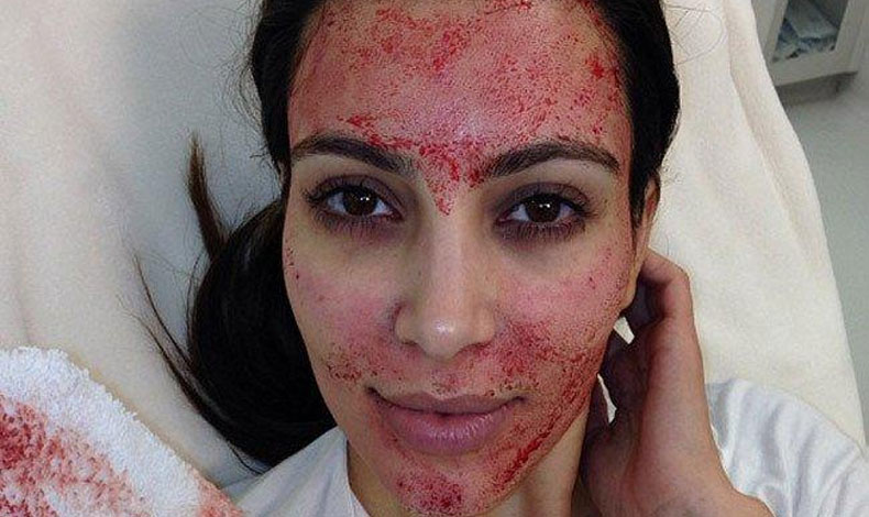 Todo acerca del famoso facial vampiro