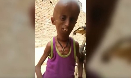 El chico de 21 aos que luce como anciano