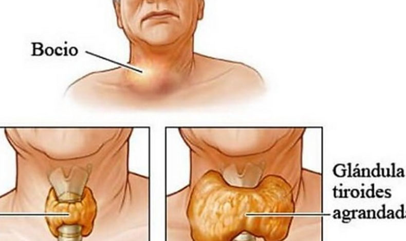 Cules son los sntomas de la tiroides?