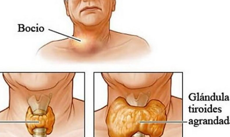 Cuales son los sintomas de la tiroides en las mujeres