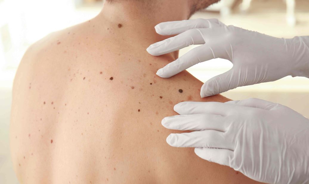 Importancia de la deteccin temprana en el tratamiento del Melanoma