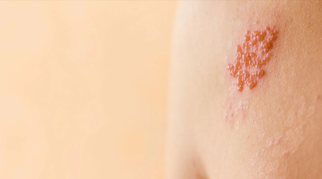 Los 7 mitos m�s comunes del herpes z�ster