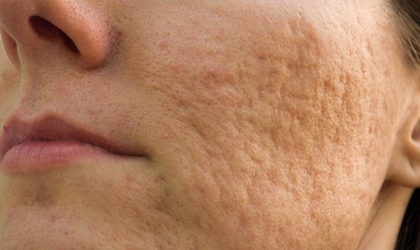 Mascarillas naturales para reducir las marcas del acn
