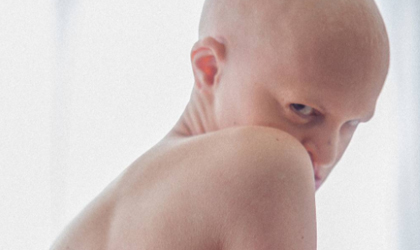 Su rareza la convirti en la modelo que rompi los estereotipos