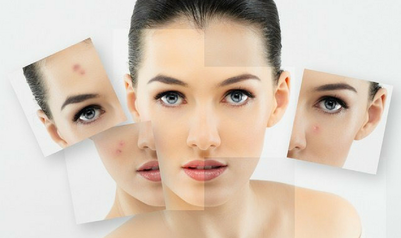 Relación entre la dieta y el acné | LatinOL.com SpotFASHION