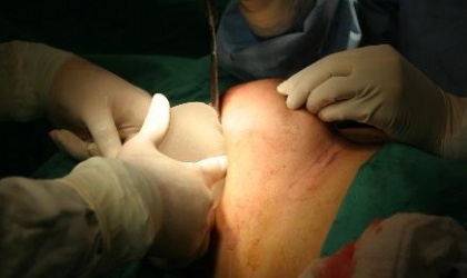 Otra paname�a con droga en implantes detenida en Colombia