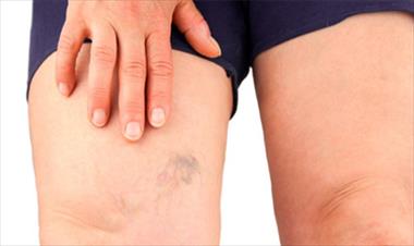 /vidasocial/6-consejos-para-prevenir-las-varices/42202.html