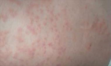 /vidasocial/minsa-confirma-268-casos-de-alergias-por-pelusa-de-polillas/89092.html
