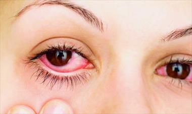 /vidasocial/se-prenden-las-alarmas-por-incremento-en-los-casos-de-conjuntivitis/57522.html