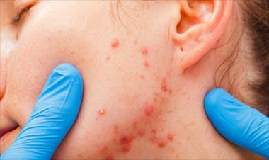 /vidasocial/productos-naturales-para-combatir-el-acne-quistico/51977.html