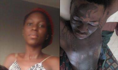 /vidasocial/su-ex-novia-le-arrojo-acido-y-el-no-le-guarda-rencor/47384.html