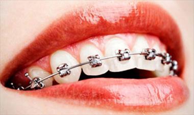 /spotfashion/presumir-los-brackets-es-una-tendencia/50432.html