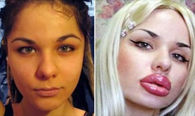 /vidasocial/se-deforma-su-rostro-por-querer-labios-mas-grandes/12988.html