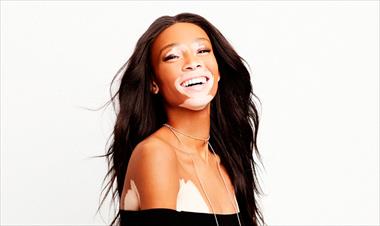 /spotfashion/modelo-con-vitiligo-se-muestra-orgullosa-en-instagram/60996.html