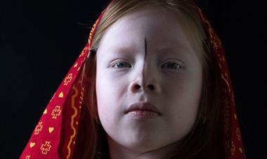 /vidasocial/sos-albinos-panama/78128.html