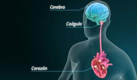 Qu es la fibrilacin auricular?