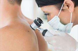En este verano el melanoma es el cncer de piel ms agresivo que existe y se puede confundir con un lunar